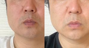 VOICE2 BEFORE / AFTER 使い始めて3日目くらいに変化が